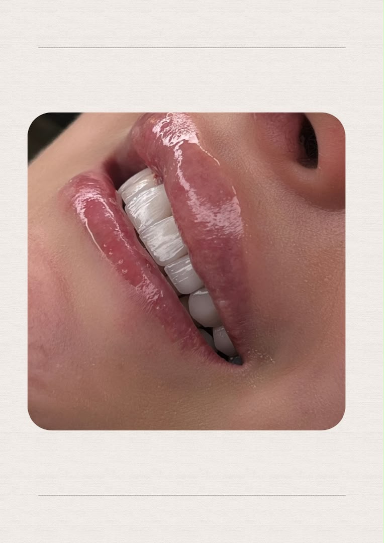 لمینت و طراحی لبخند