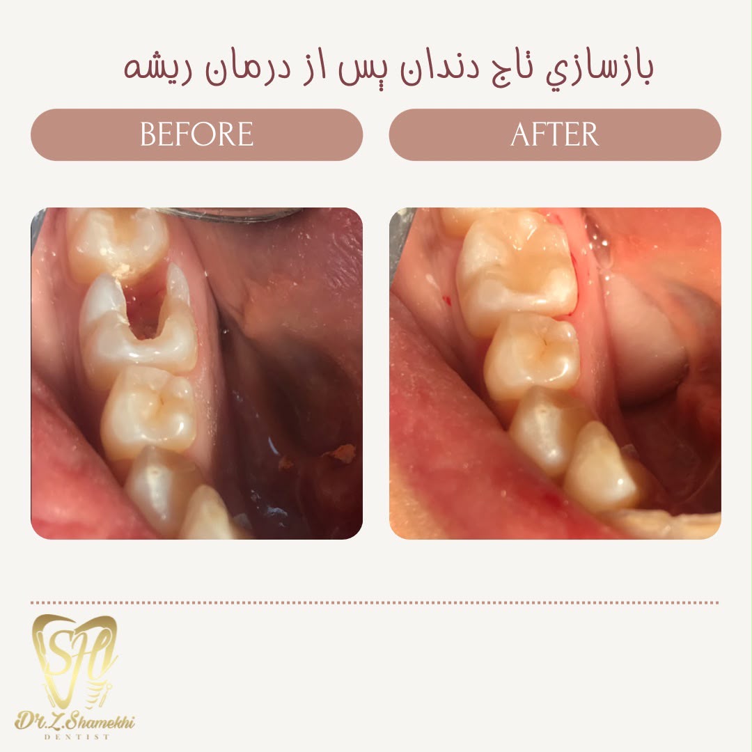 بازسازی تاج دندان پس از درمان ریشه