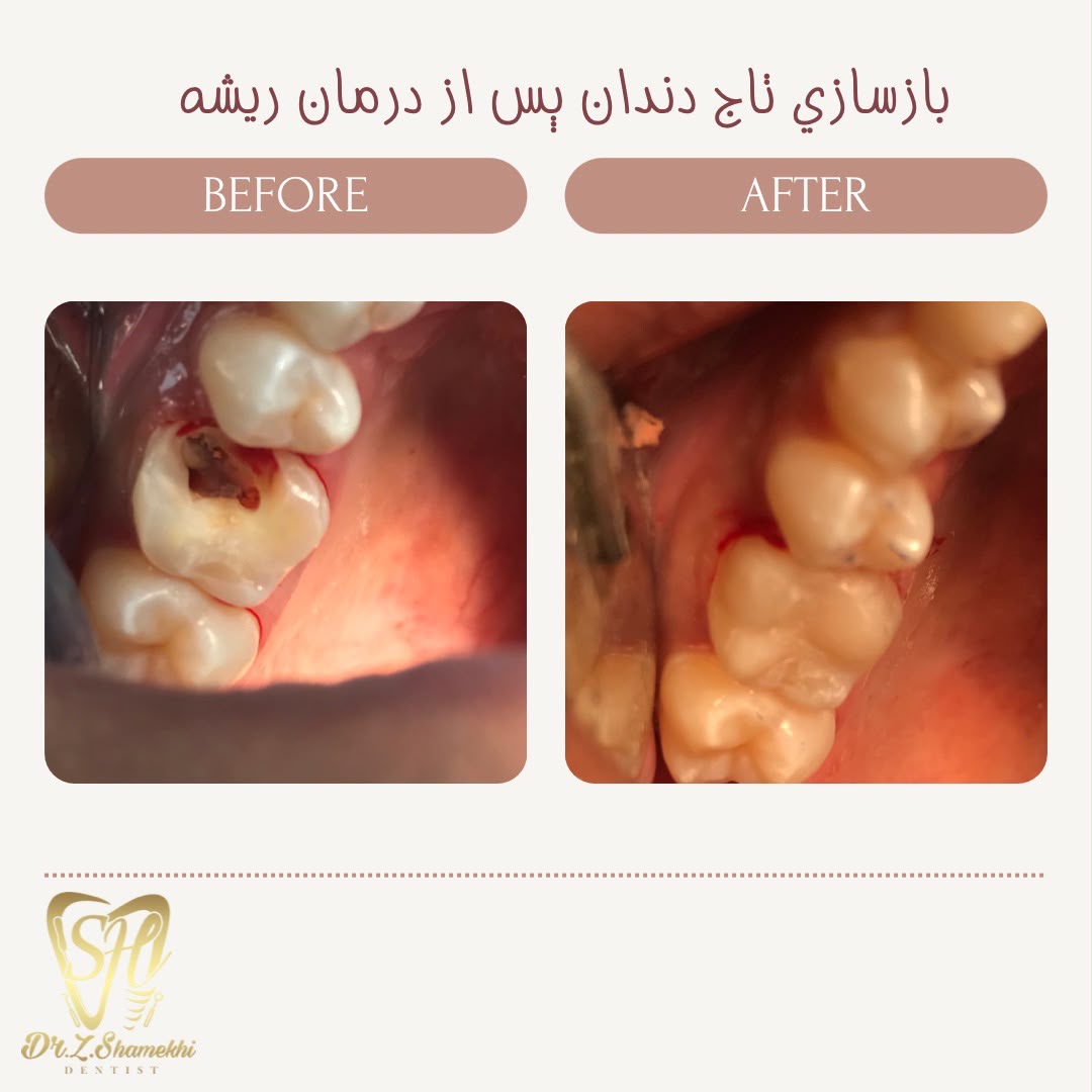 بازسازی تاج دندان پس از درمان ریشه