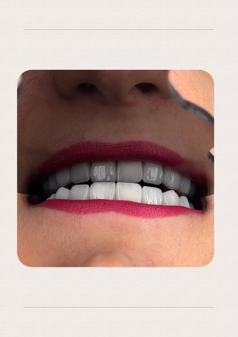 لمینت و طراحی لبخند