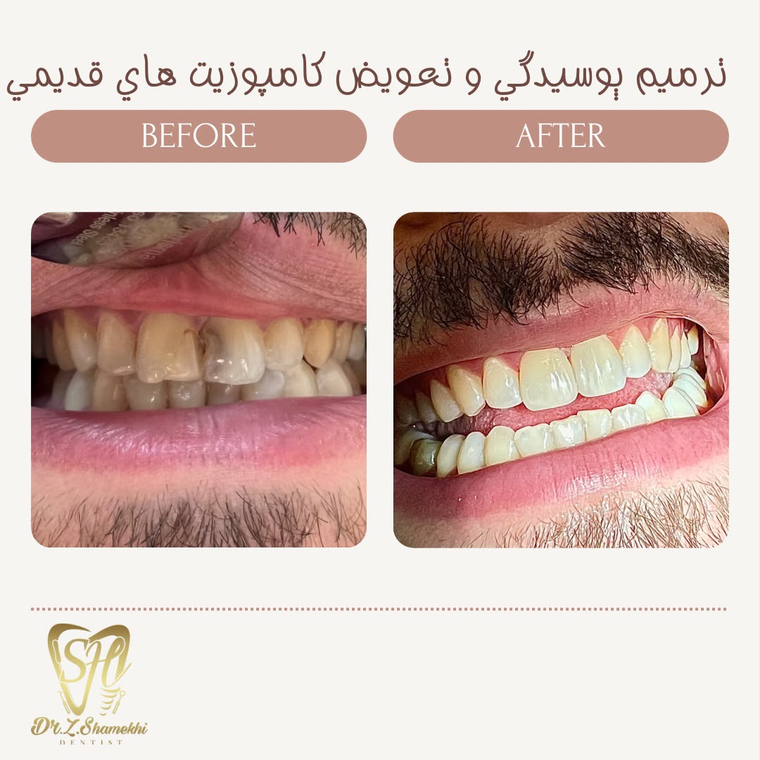 ترمیم پوسیدگی و تعویض کامپوزیت‌های قدیمی
