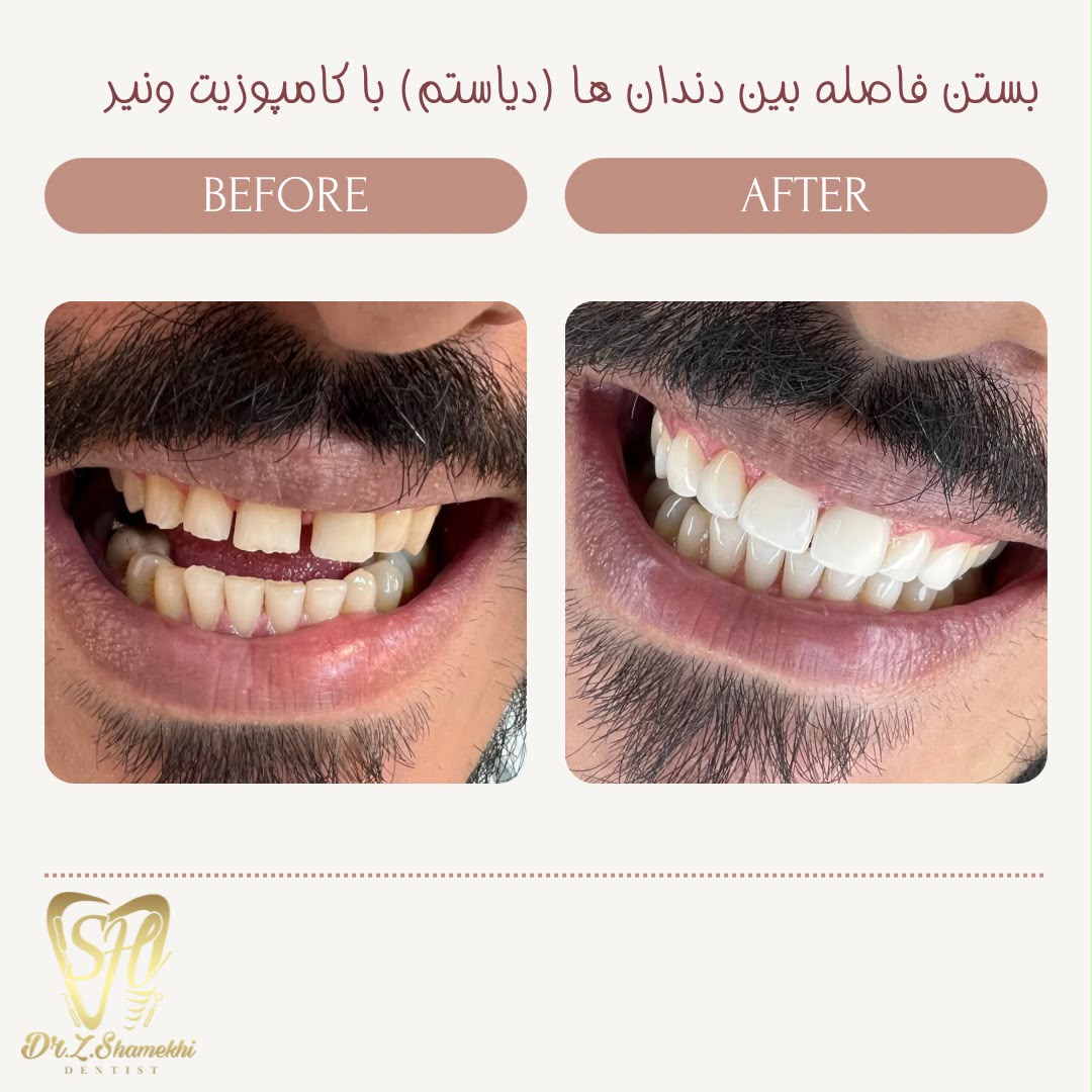 بستن فاصله بین دندان‌ها با کامپوزیت ونیر
