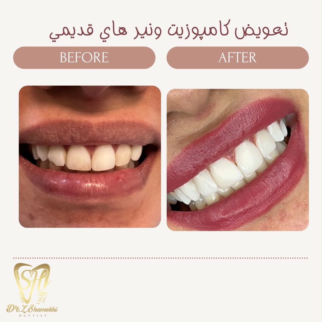 تعویض کامپوزیت ونیرهای قدیمی