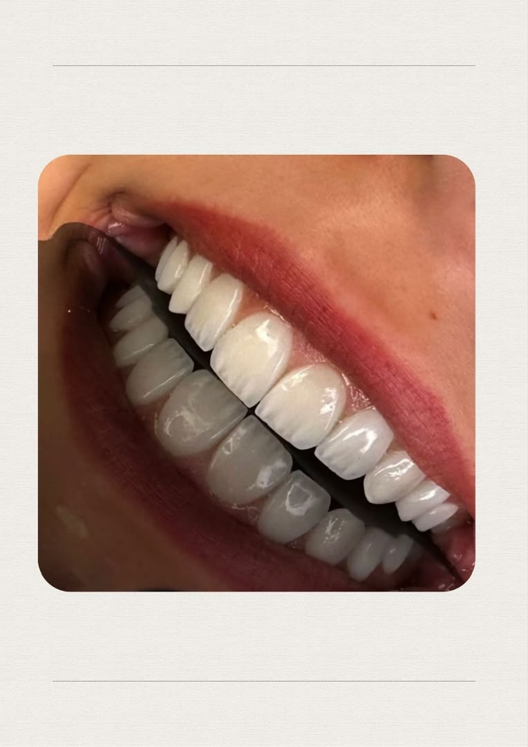 لمینت و طراحی لبخند