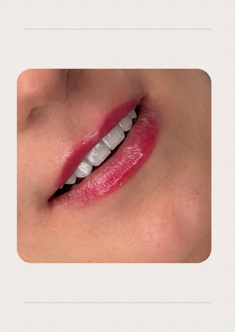 لمینت و طراحی لبخند
