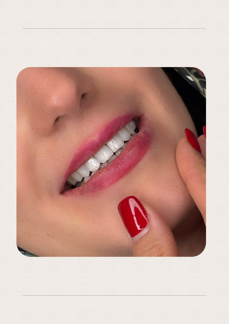 لمینت و طراحی لبخند