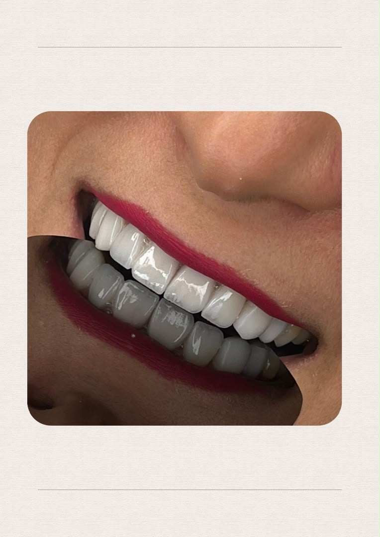 لمینت و طراحی لبخند
