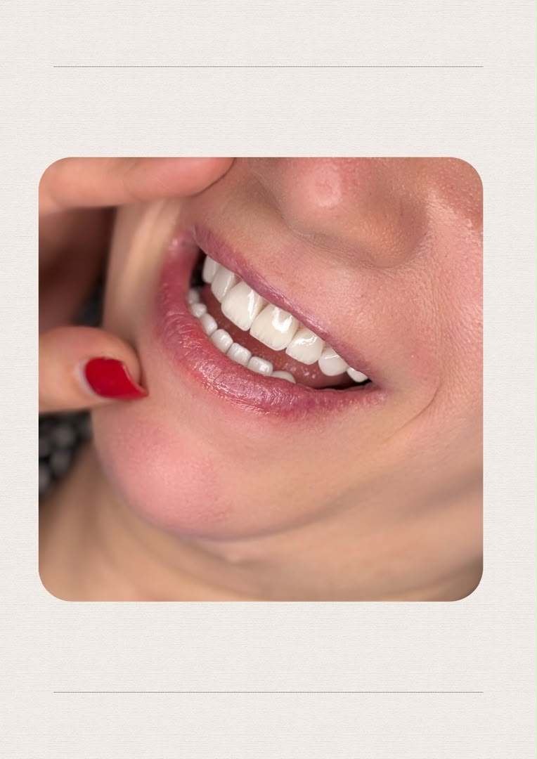 لمینت و طراحی لبخند