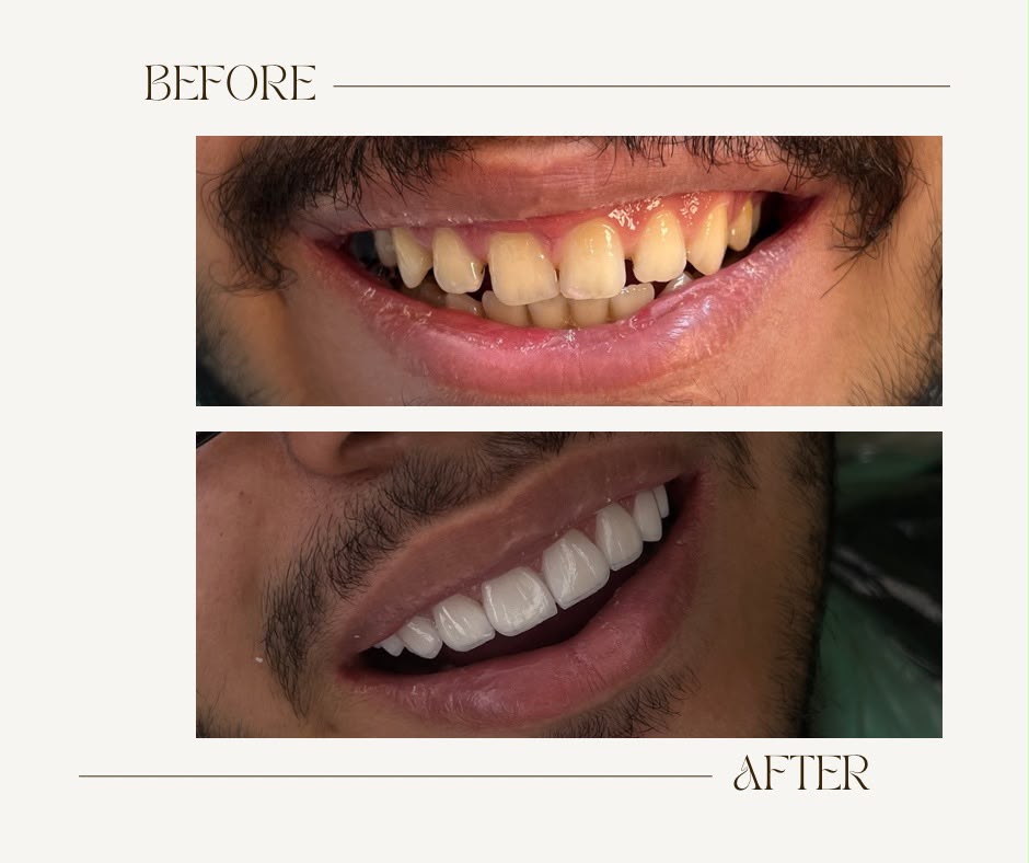 لمینت و طراحی لبخند
