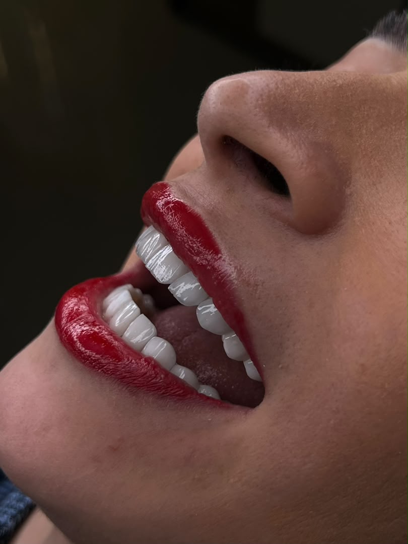 لمینت و طراحی لبخند