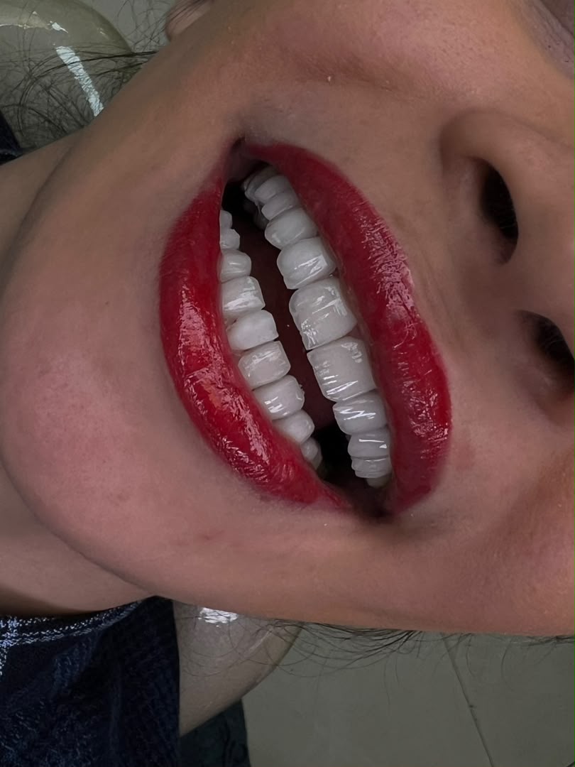 لمینت و طراحی لبخند